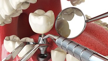 Implant topography and dental care instrument surface characterization Implant topography and dental care instrument surface characterization