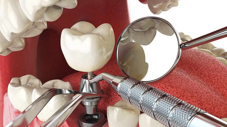 Implant topography and dental care instrument surface characterization Implant topography and dental care instrument surface characterization